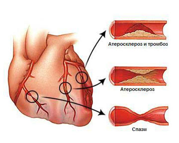 Атеросклероз аорты сердца — детально о важном!